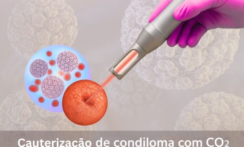 Cauterização de Condilomas com CO2