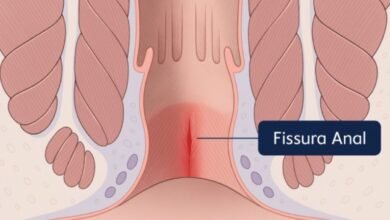 Fissura Anal e Dor Crônica: Guia de Manejo Baseado em Evidências