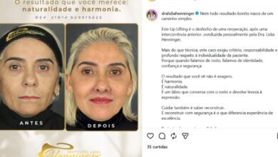 Lip Lift reparador: quando a reoperação é indicada e como buscar um resultado natural com segurança