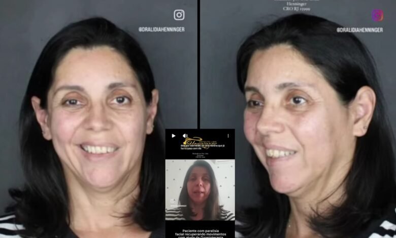 Depoimento de paciente com paralisia facial tratada com ozonioterapia