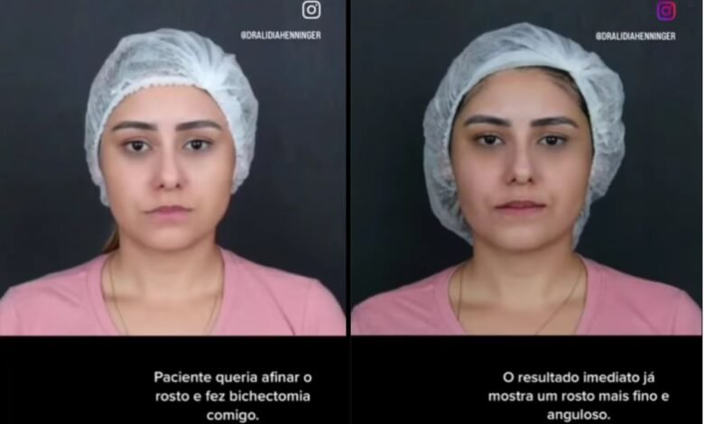Depoimento de paciente que fez bichectomia: como foi a cirurgia e o resultado imediato