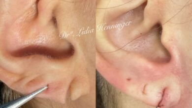 Lobuloplastia: como a reconstrução do lóbulo da orelha devolve estética, função e autoestima