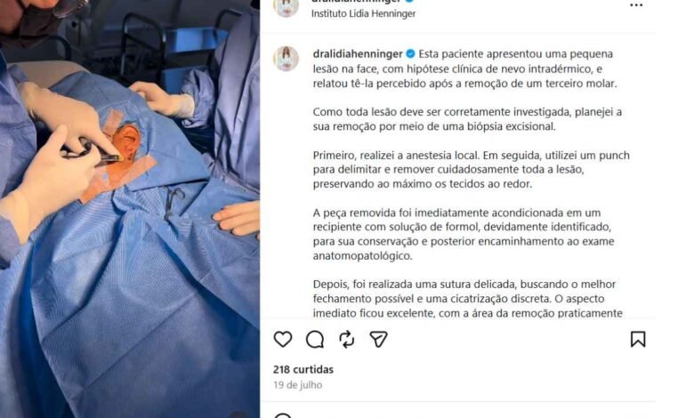 Biópsia excisional de lesão facial: diagnóstico seguro